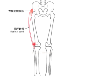 腸脛靱帯炎と大腿骨外顆の部分が赤くなっている
