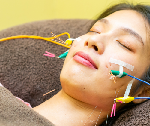 Acupuncture is being applied to the face. A pulsed electric current is being passed through the needles.