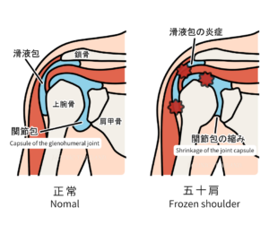 肩の関節包のイラスト。正常な関節包と五十肩で収縮した関節包の比較