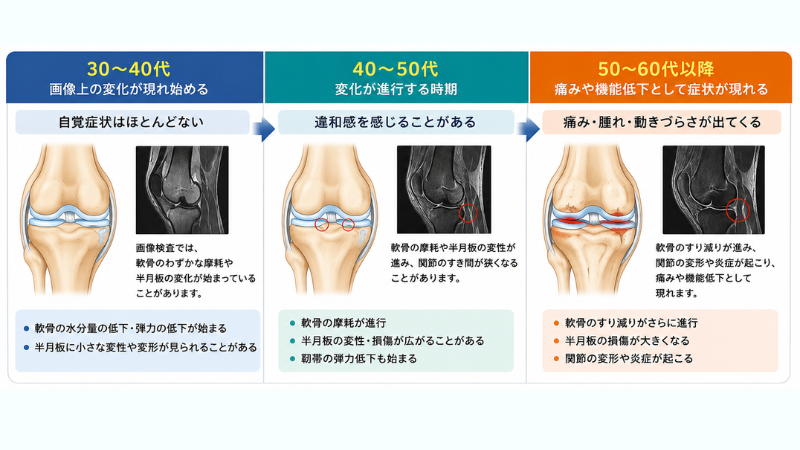 30〜40代から始まる膝の退行性変化の進行を示した図。30〜40代では画像上の変化が現れ始めるものの自覚症状は少なく、40〜50代で変化が進行し、50〜60代以降になると痛みや機能低下として症状が現れる過程を画像で説明している