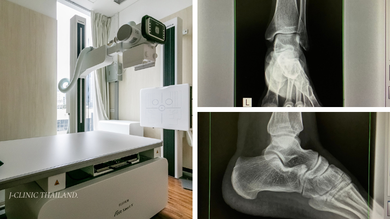 J-CLINICで行った足首のレントゲン検査。正面・側面のX線画像を用いて、骨折の有無や関節の状態を評価し、足首の捻挫や古傷による痛みの原因を確認します。