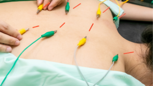 鍼が打たれている女性の背中