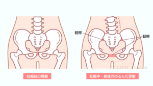 産前と産後で骨盤が開いているいることを説明する画像