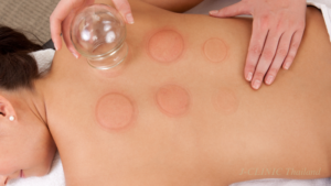 カッピングをして、跡がついている女性の背中