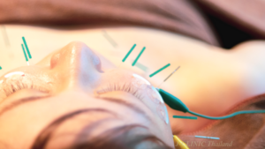 顔に鍼が打たれている、パルス電気が鍼についている