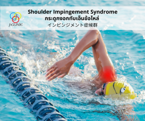 Impingement syndrome