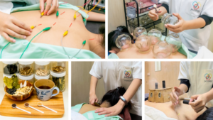 鍼治療、カッピング、漢方薬、カッサ、灸治療の写真