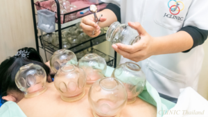 左手にガラスカップ、右手に火がついた器具をもったセラピスト