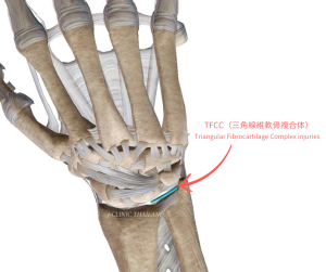 TFCC（三角線維軟骨複合体） Triangular Fibrocartilage Complex injuries のイラスト