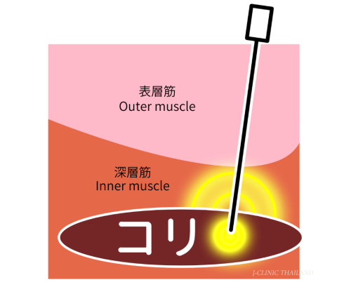 表層筋と深層筋のイラスト、深層筋にあるコリに鍼があたっている