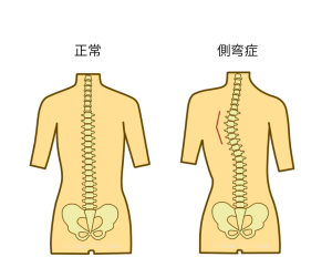 正常の背骨と側弯症の背骨のイラスト