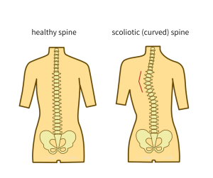 healthy spine and scoliotic (curved) spine