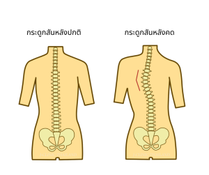 กระดูกสันหลังปกติ กระดูกสันหลังคด