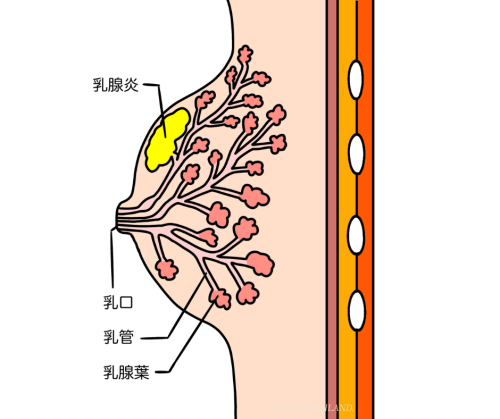 乳房で乳腺炎がおきているイラスト