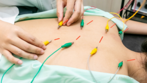 鍼を打って、そこにパルス電流を流す施術をしている