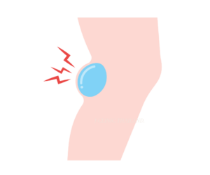 膝の裏側に水のような塊があるイラスト