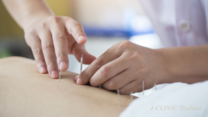鍼治療をしているセラピスト
